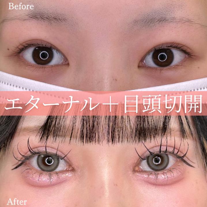 双眼皮手术