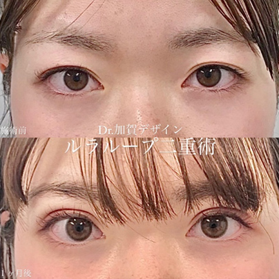 双眼皮手术