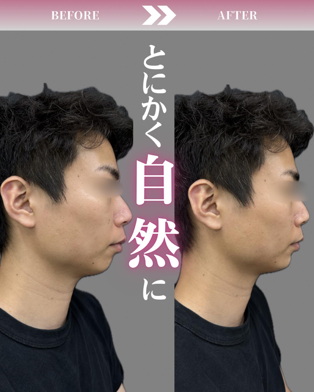 玻尿酸填充