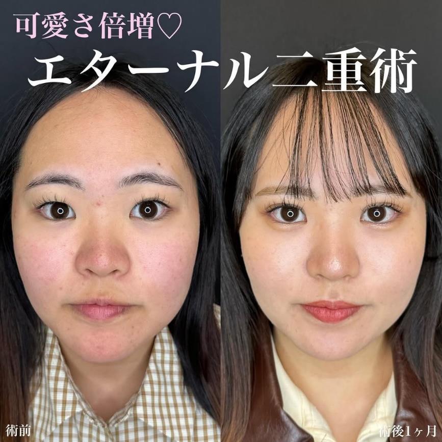 双眼皮手术
