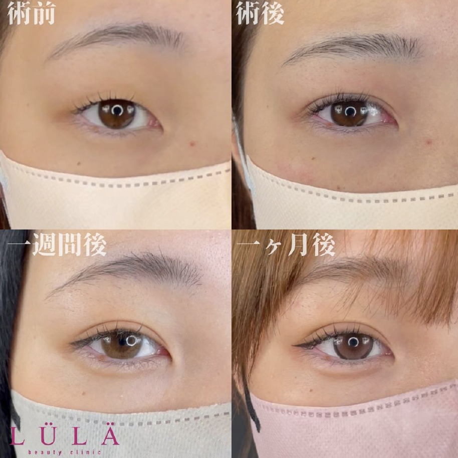双眼皮手术