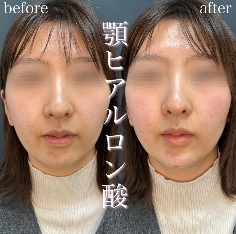 玻尿酸填充