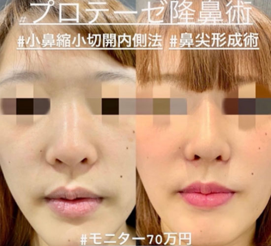 鼻综合整形 + 鼻梁整形 - 硅胶假体 + 鼻尖整形 - 切开法