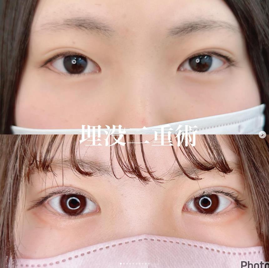双眼皮手术