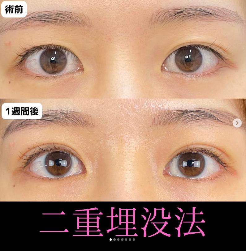 双眼皮手术