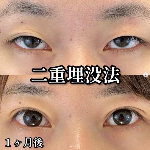 双眼皮手术