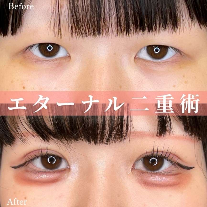 双眼皮手术