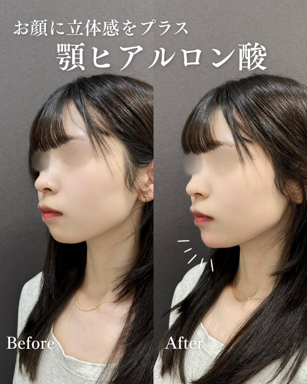 玻尿酸填充