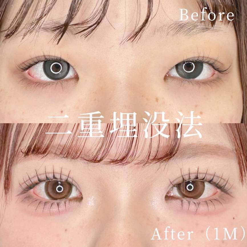 双眼皮手术