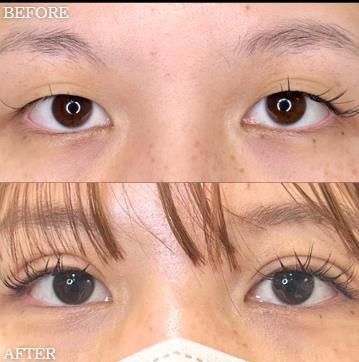 双眼皮手术
