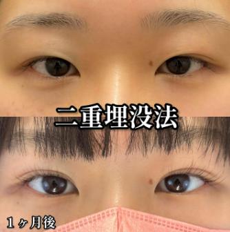 双眼皮手术