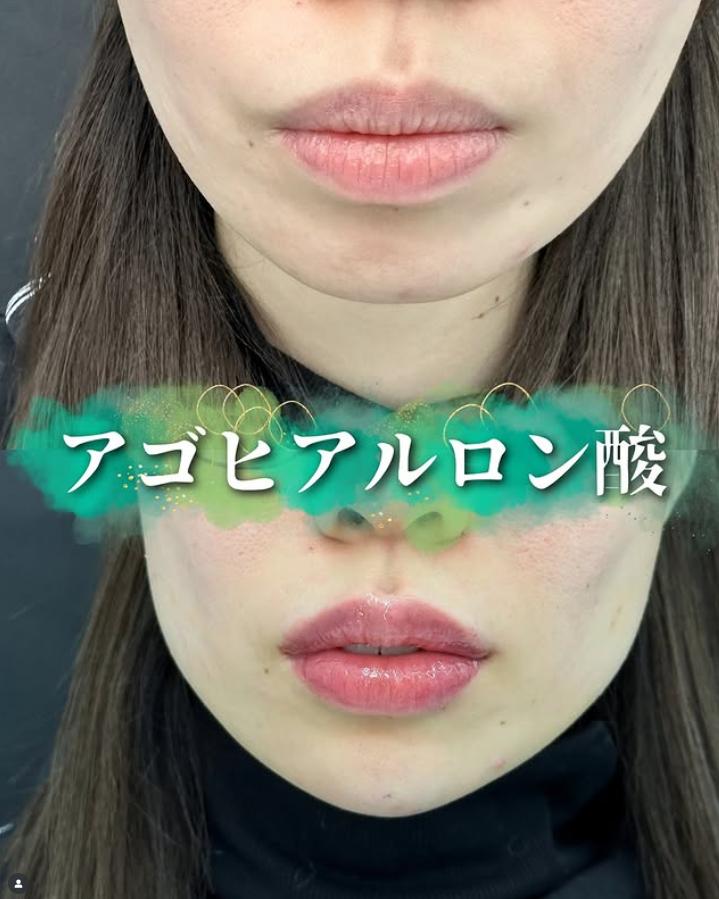 玻尿酸填充
