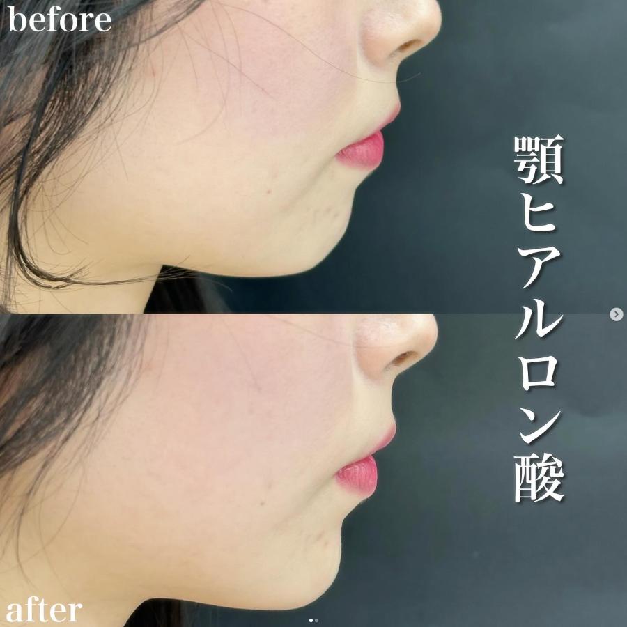 玻尿酸填充