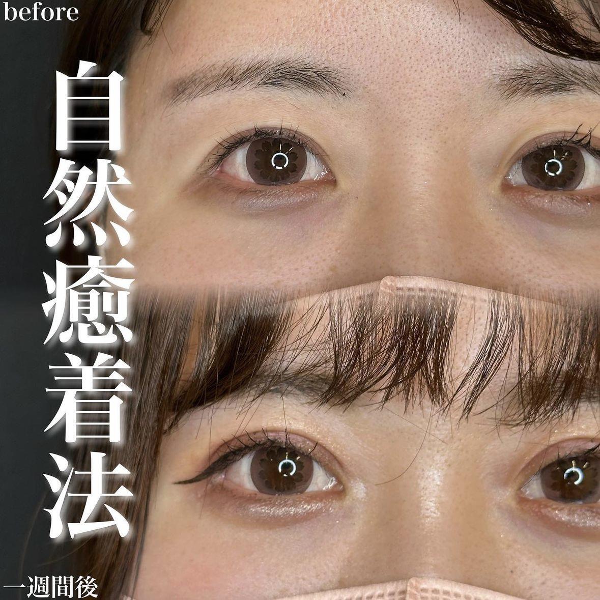 双眼皮手术