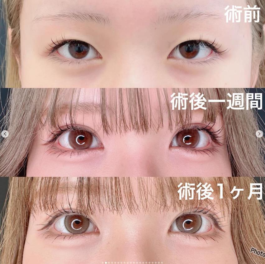 双眼皮手术