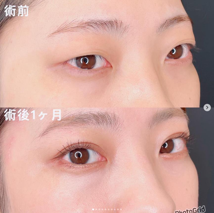 双眼皮手术