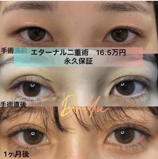 双眼皮手术