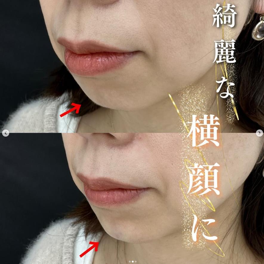 玻尿酸填充