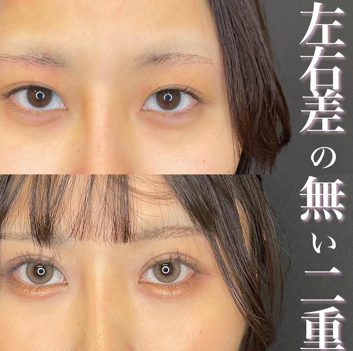 双眼皮手术