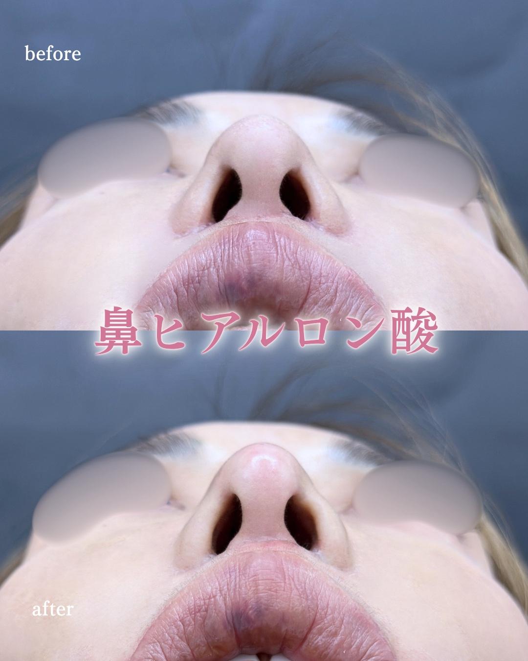 玻尿酸填充