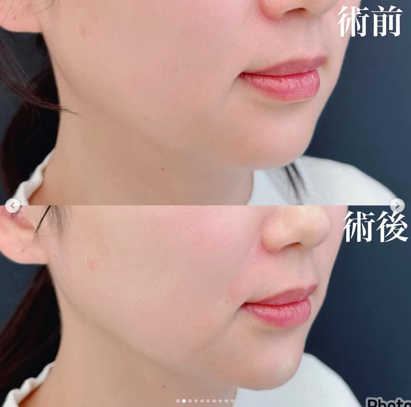 玻尿酸填充