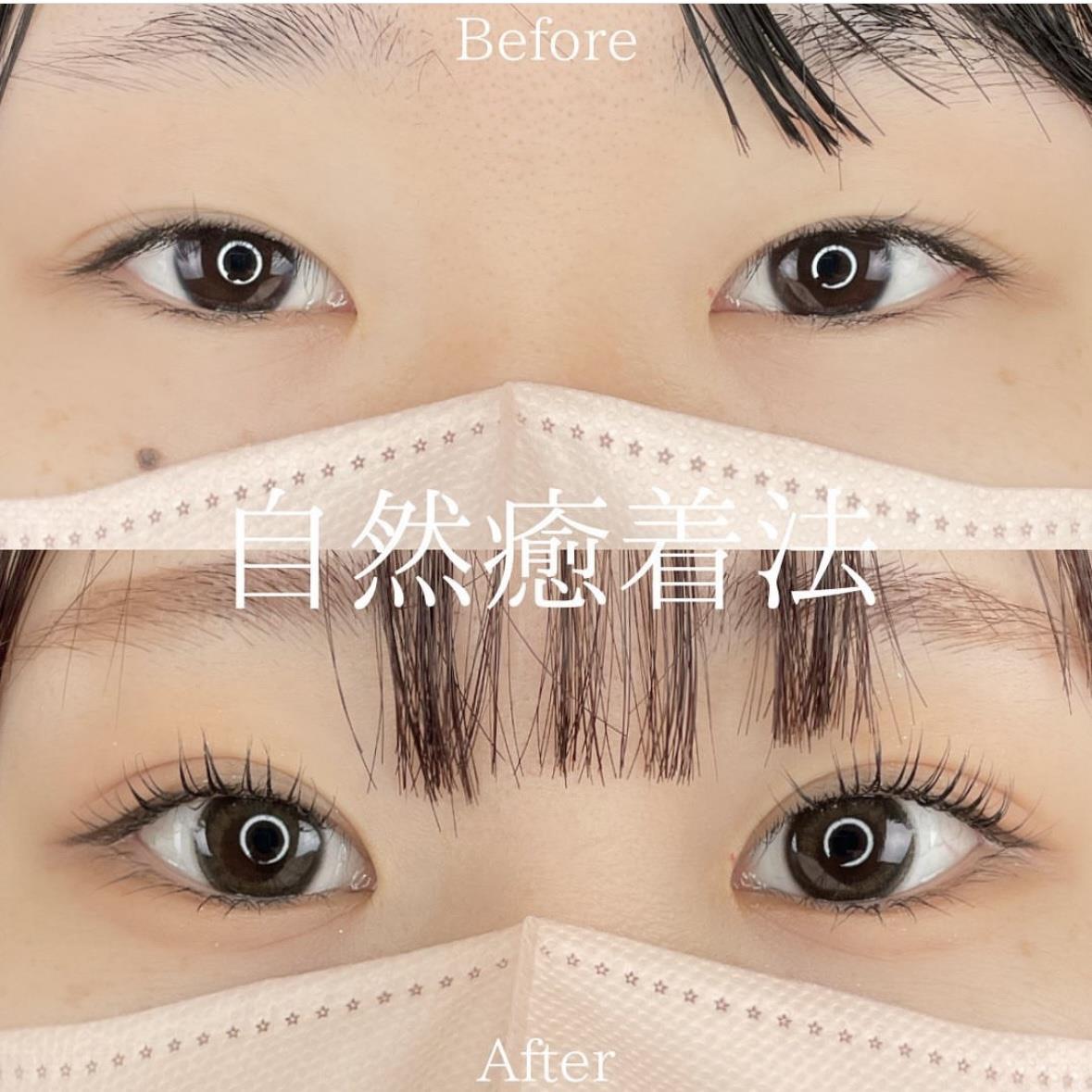 双眼皮手术