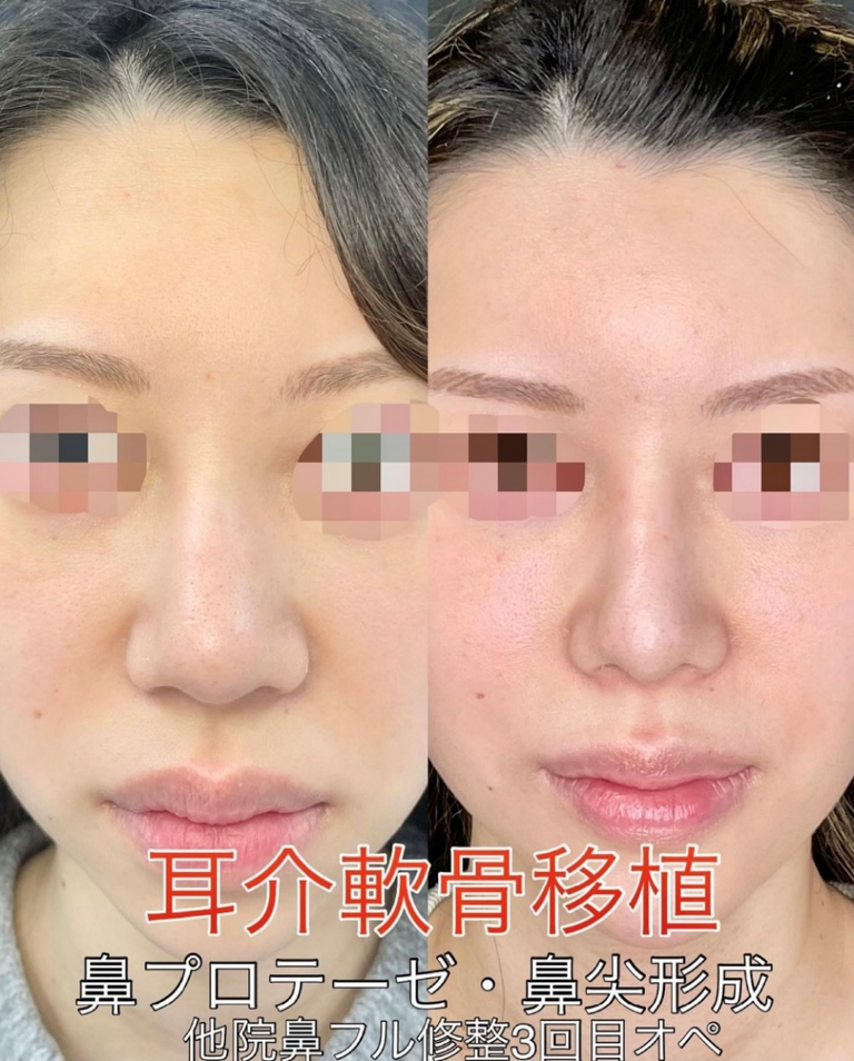 鼻综合整形 + 鼻梁整形 - 硅胶假体 + 鼻尖整形 - 切开法
