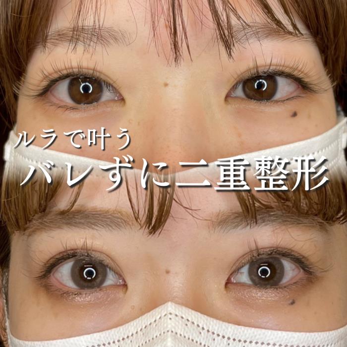 双眼皮手术