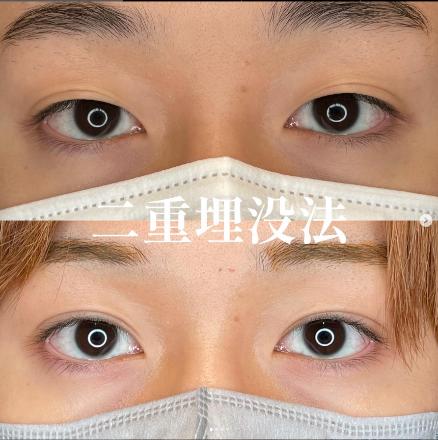 双眼皮手术