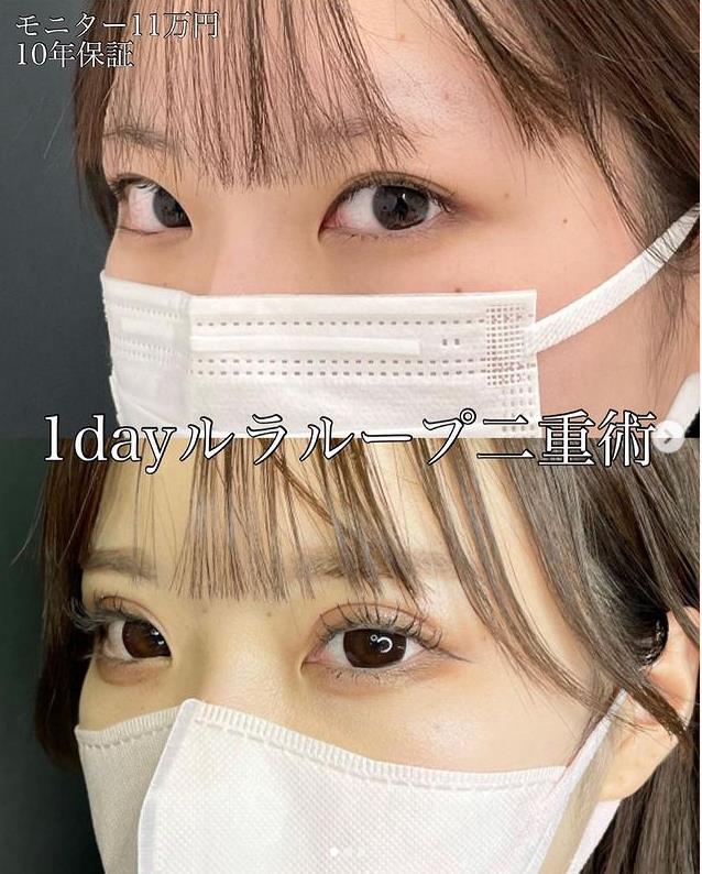 双眼皮手术