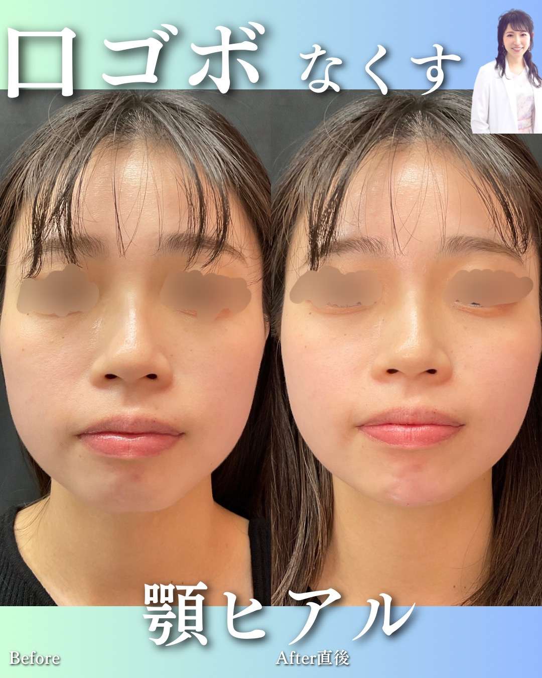 玻尿酸填充
