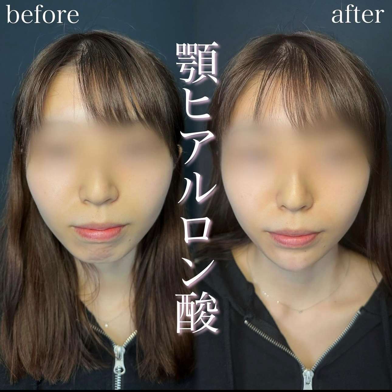 玻尿酸填充