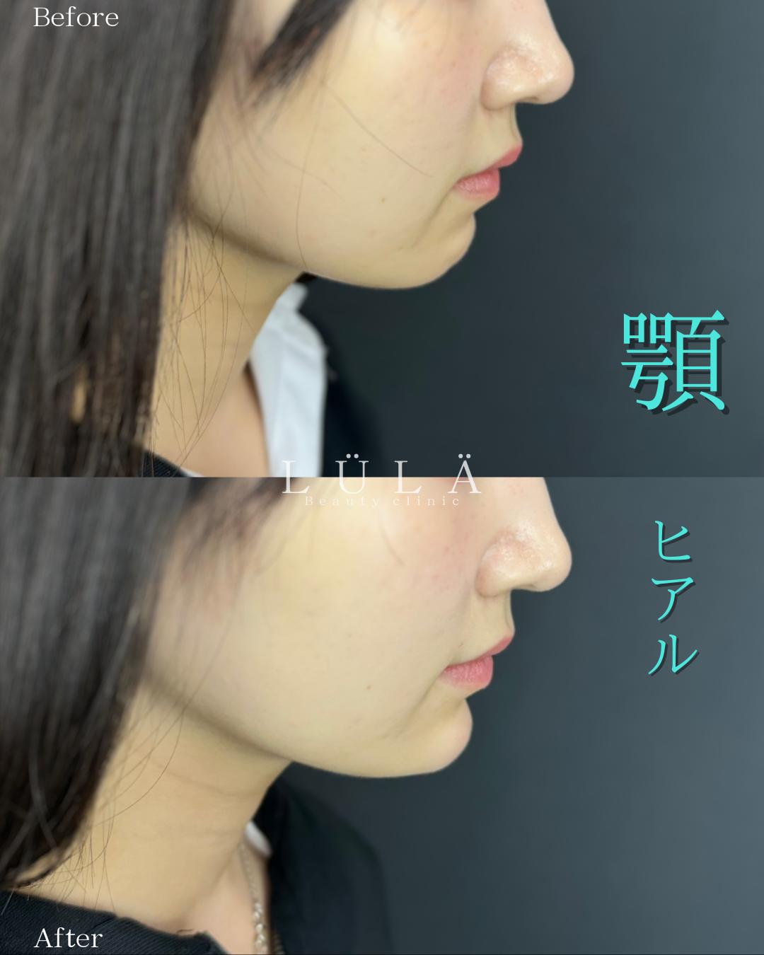 玻尿酸填充