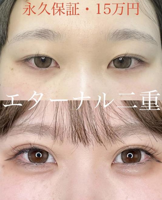 双眼皮手术