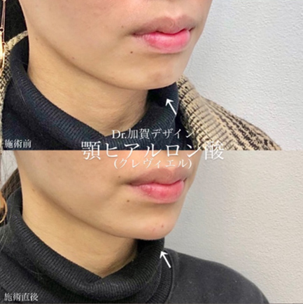 玻尿酸填充