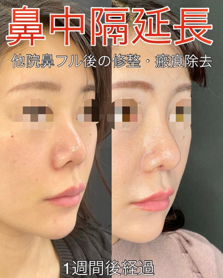 鼻综合整形 + 鼻梁整形 - 硅胶假体 + 鼻尖整形 - 切开法 + 鼻尖整形 - 鼻中隔延长术