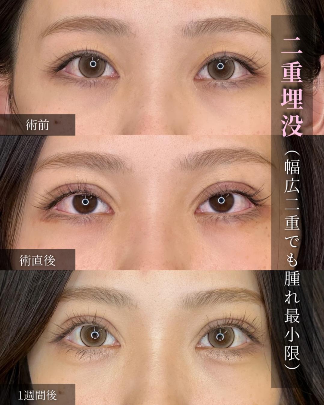 双眼皮手术