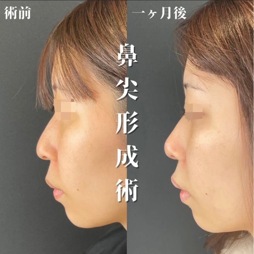 鼻综合整形 + 鼻尖整形 - 切开法
