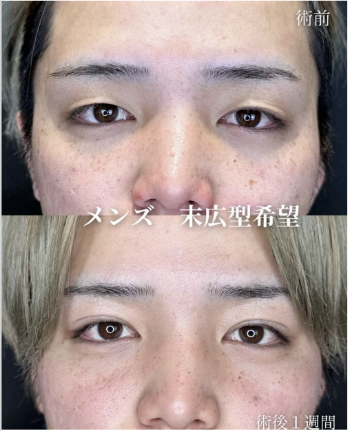双眼皮手术