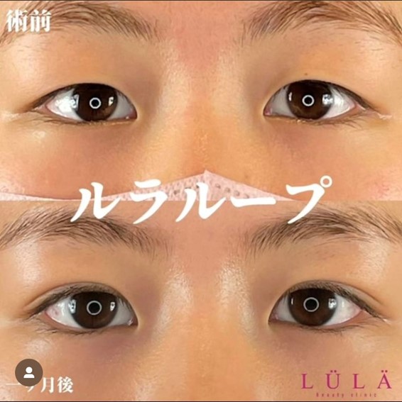 双眼皮手术