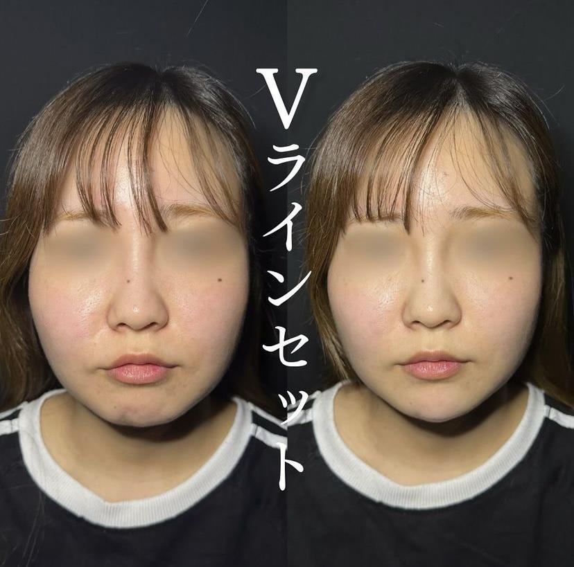 玻尿酸填充 + 咬肌瘦脸针
