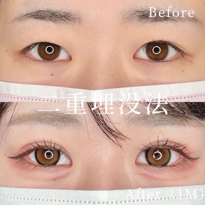 双眼皮手术