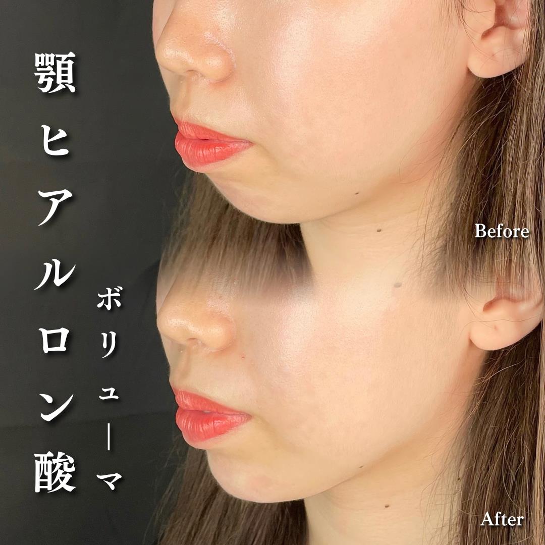 玻尿酸填充