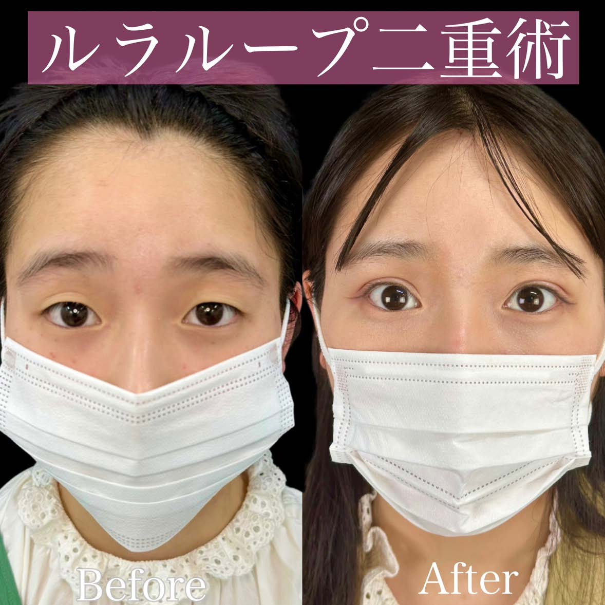 双眼皮手术