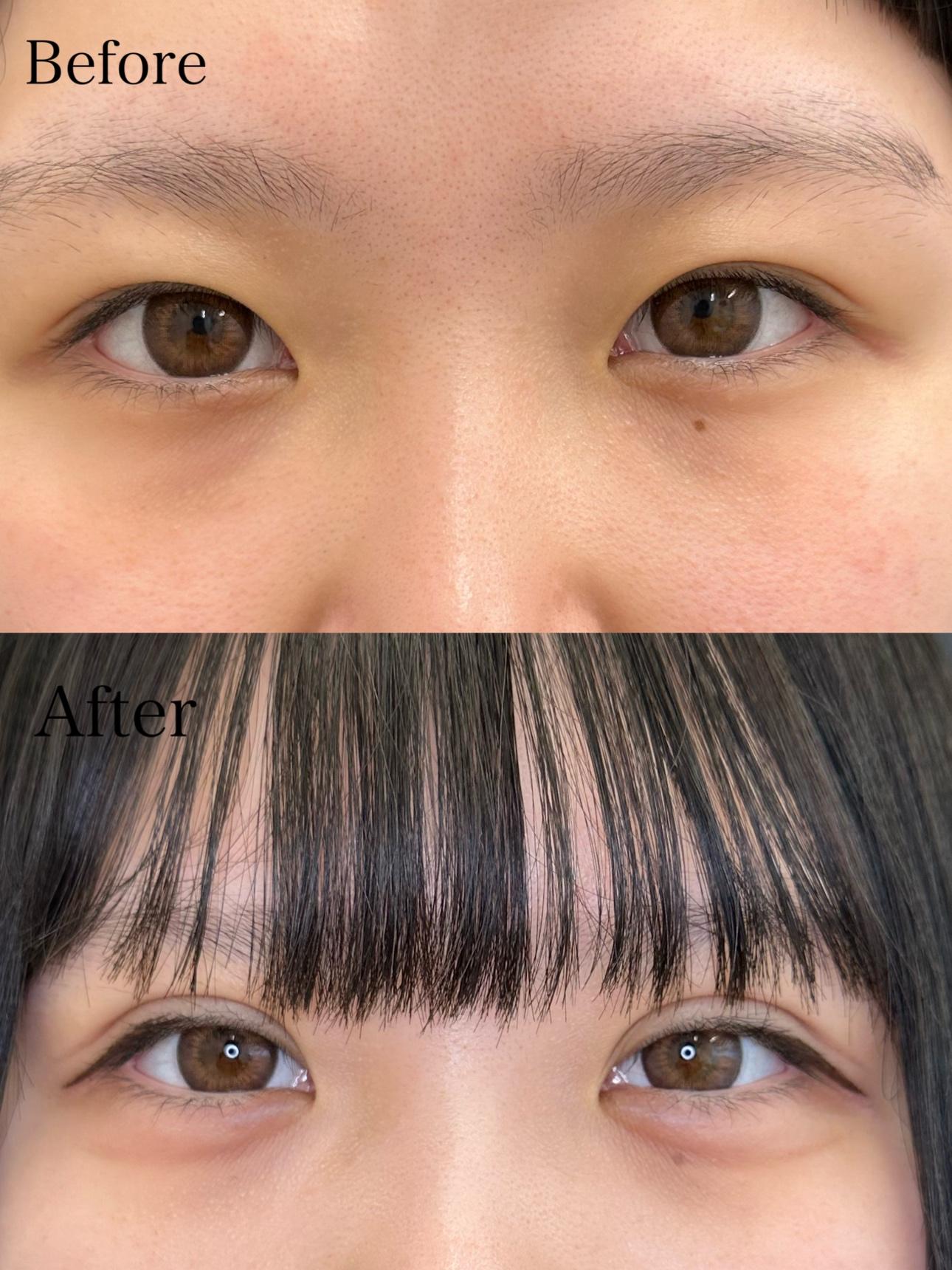 双眼皮手术