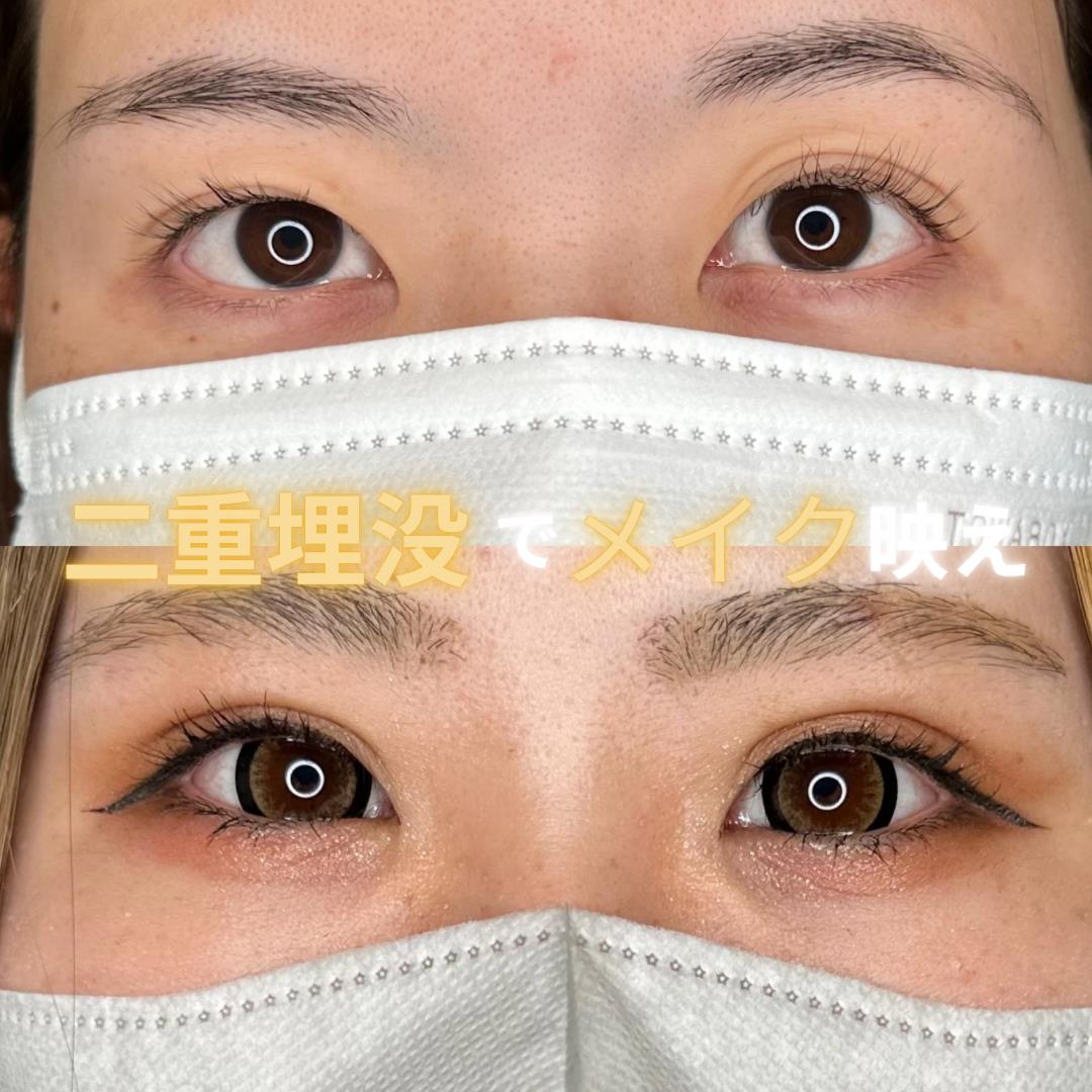双眼皮手术