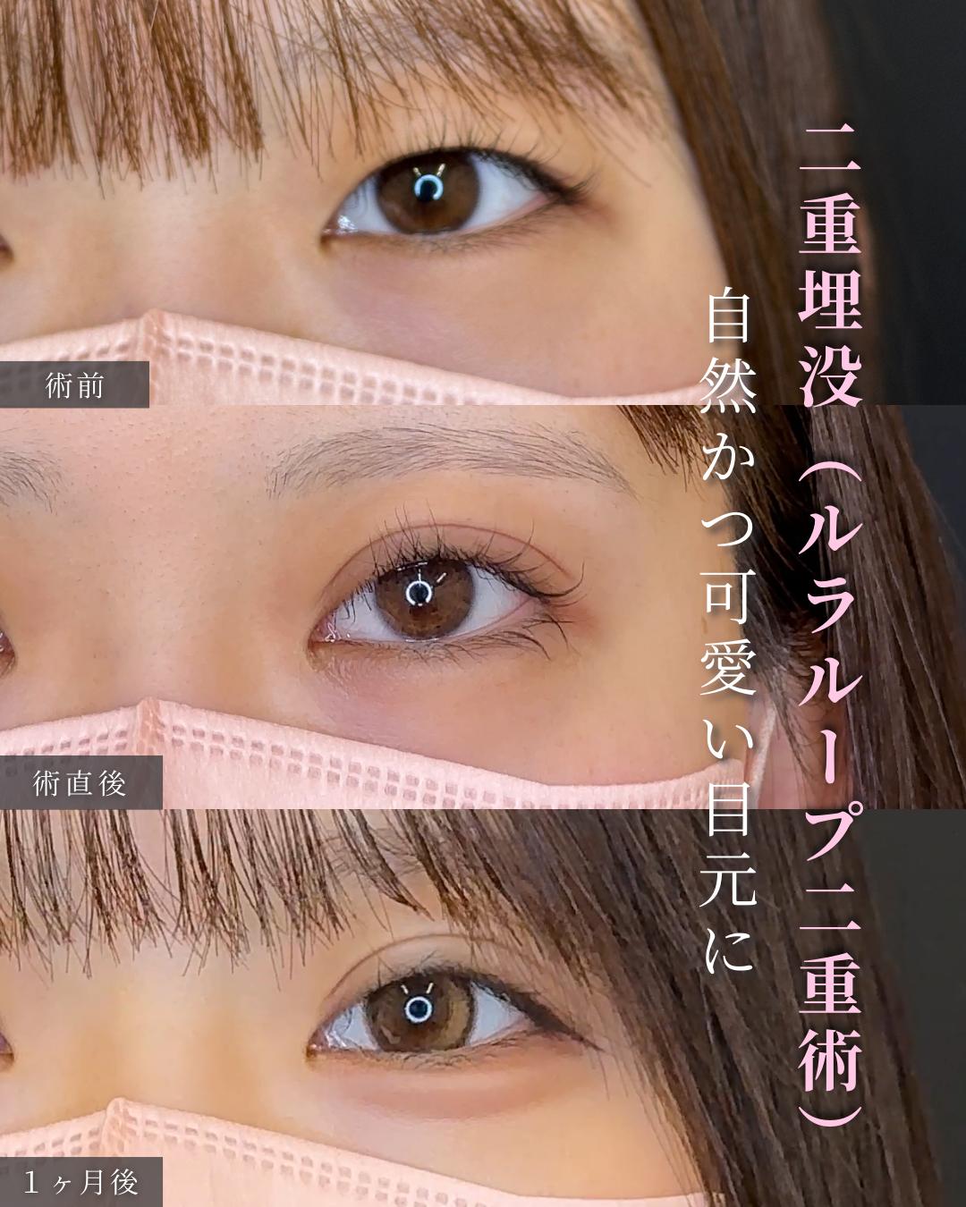 双眼皮手术