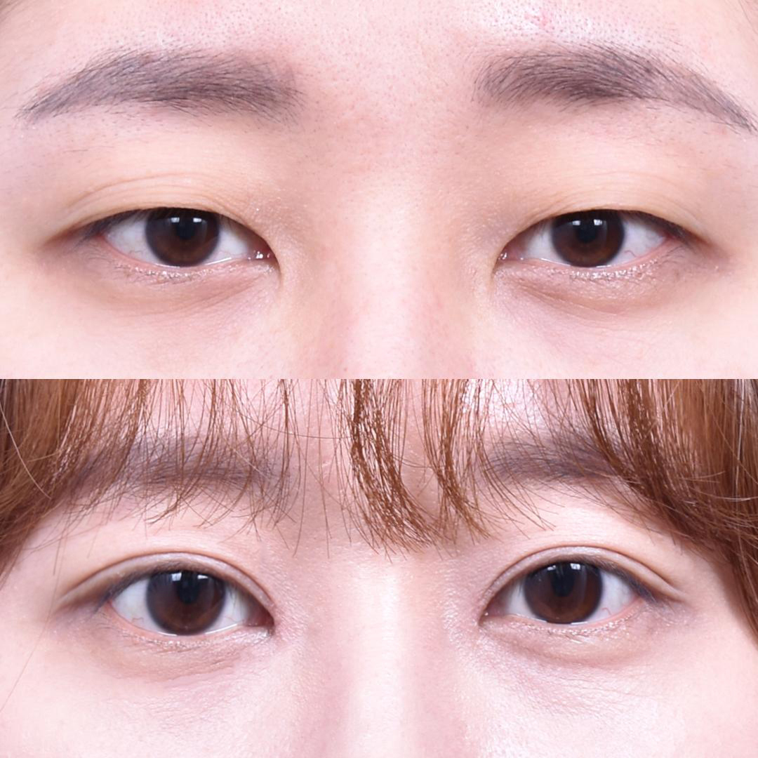 Non-Incisional Eye Lid Correction + Epicanthoplasty (1 Month Later)
