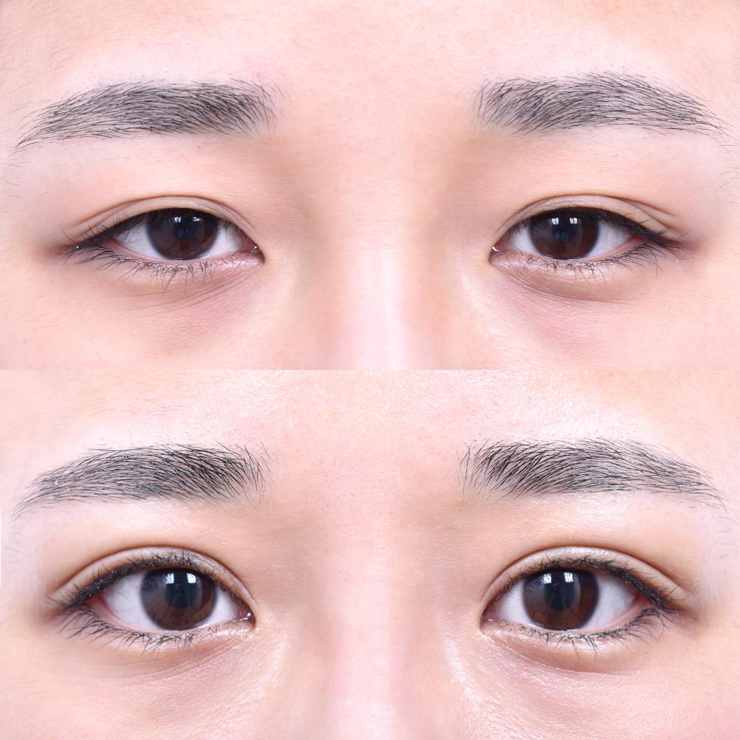 Partial Incision Eyelid Correction (After 1 Month)