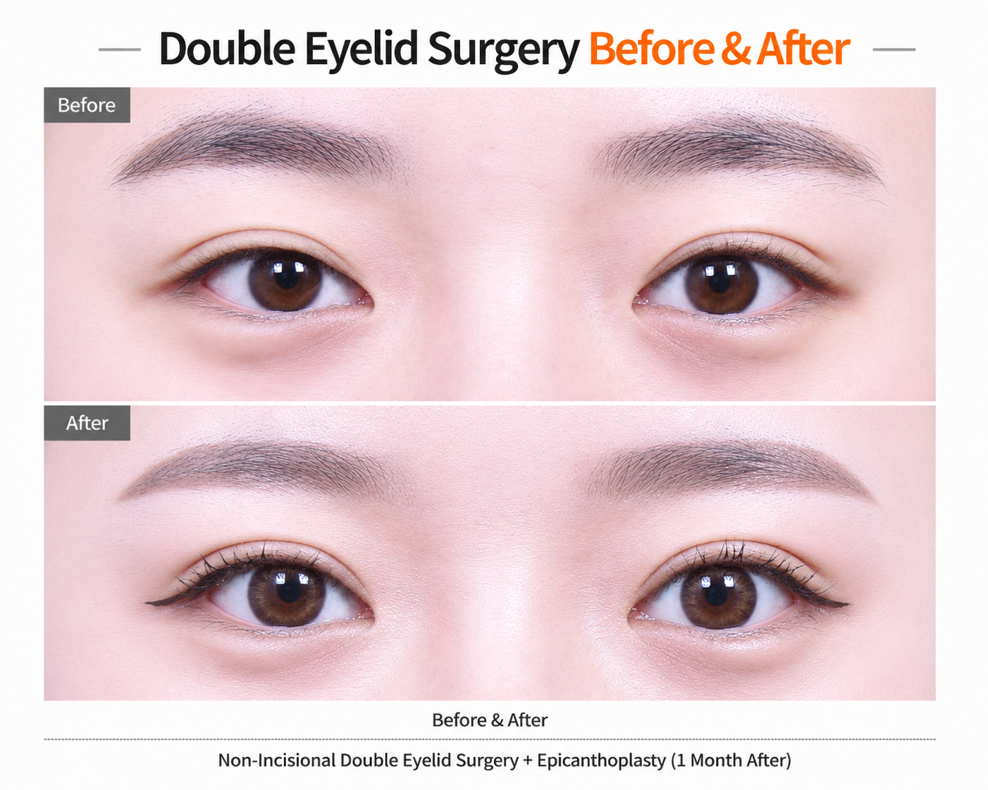 Korean double eyelid surgery